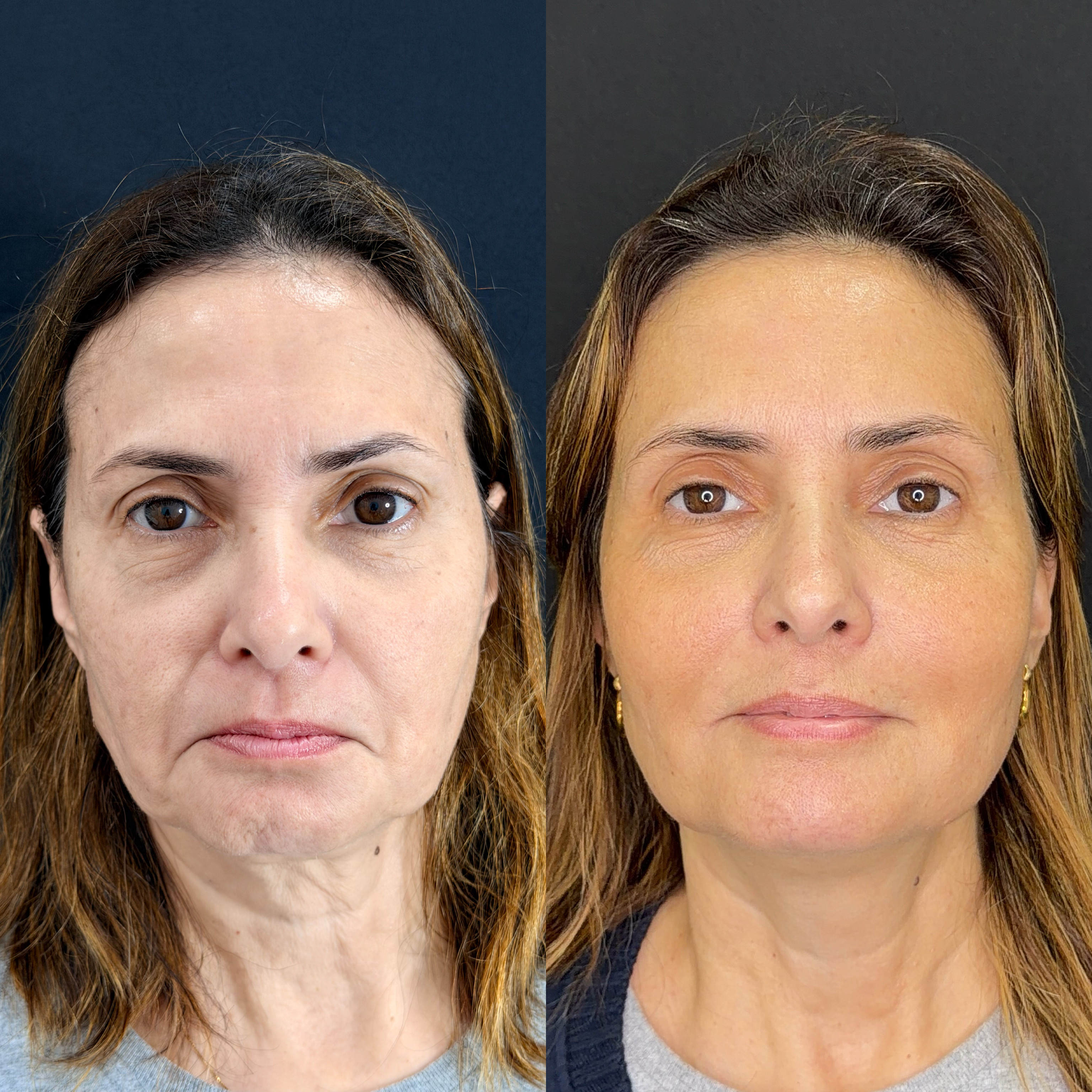 Pessoa de frente em dois registros, antes à esquerda e depois à direita.